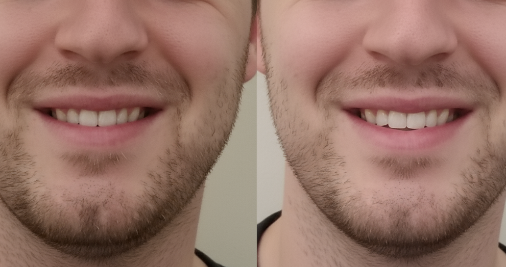 The Truth Behind Mewing Before and After Transformations